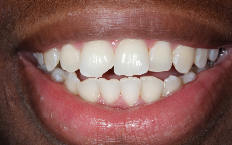 Patient smile before treatment