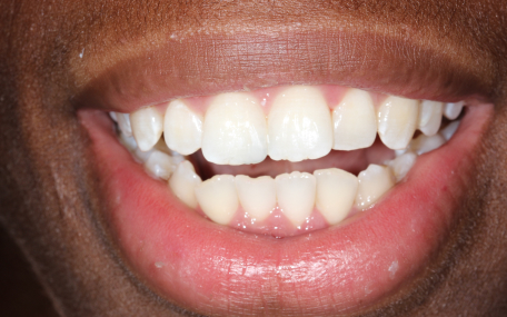 Patient smile after treatment