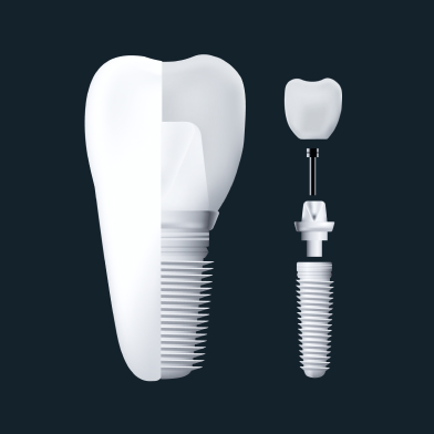 The three parts of a dental implant