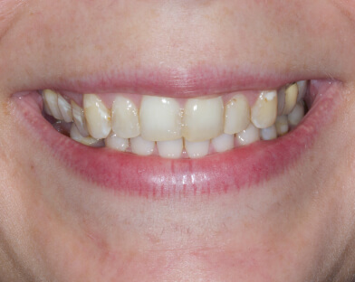 Before teeth whitening at JLM Dental Studios