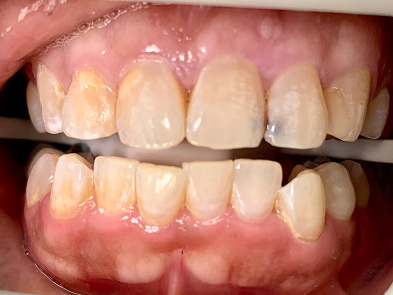 before treatment at JLM Dental Studios