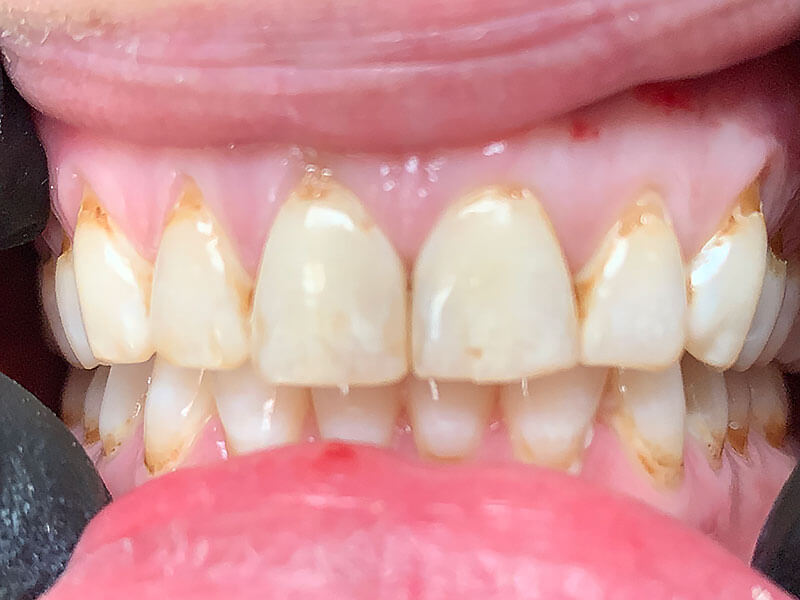 before treatment at JLM Dental Studios