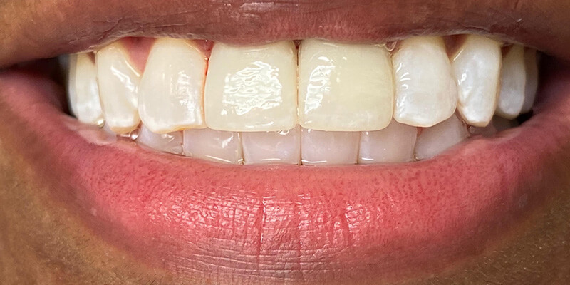 after treatment at JLM Dental Studios