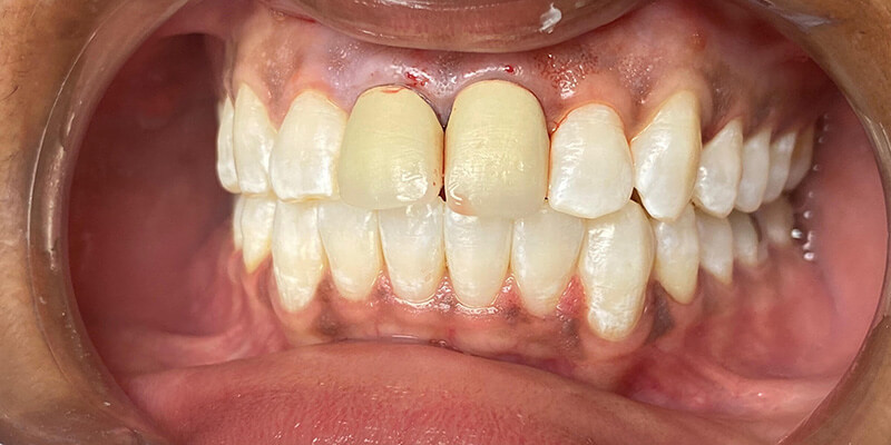 before treatment at JLM Dental Studios