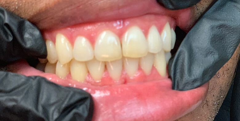 After Invisalign treatment at JLM Dental Studios