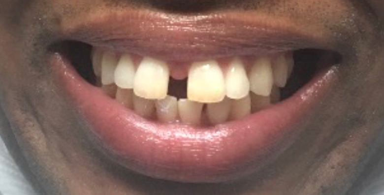 Before treatment at JLM Dental Studios