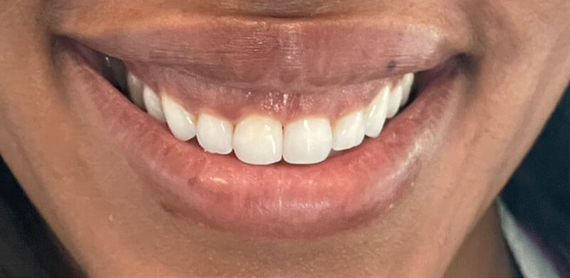 before treatment at JLM Dental Studios